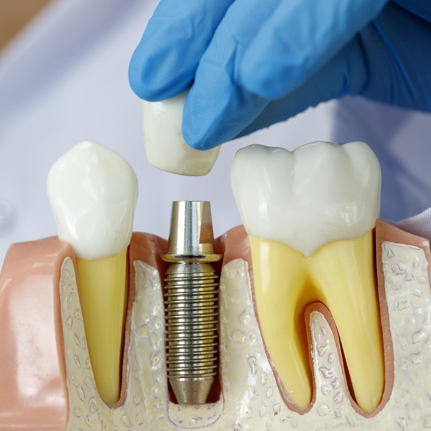 Implant Dentaire Comment Est Ce Rembourse Credit Agricole